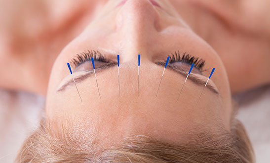 cosmetic-acupuncture